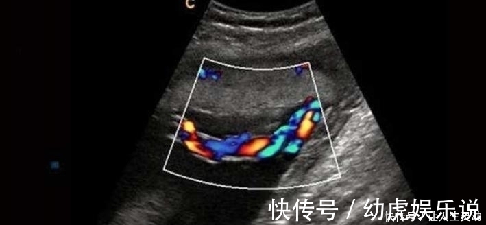 宝宝|胎儿没出生就脐带断裂,医生也无能为力,孕妈抓住宝宝求救信号