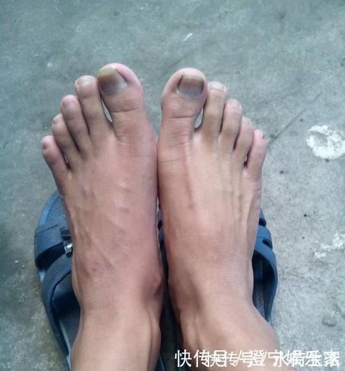 红酒|血管堵塞时，脚上或许会发出信号，若都没有，说明血栓离你还很远