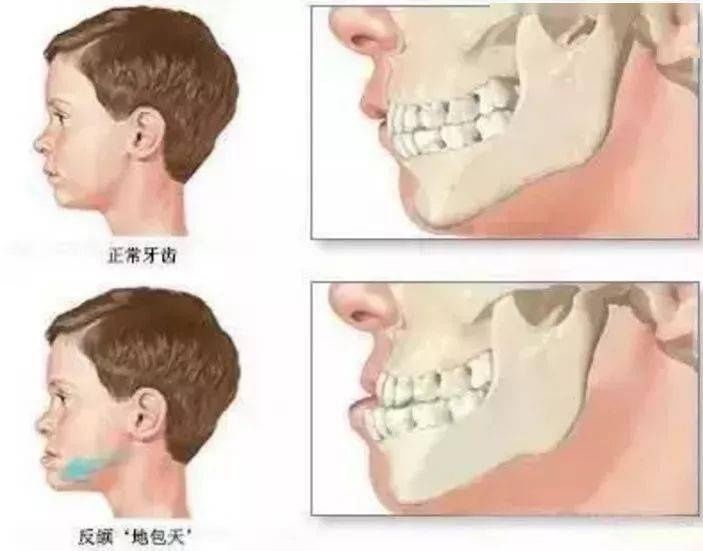 地包|儿童反合（地包天）的危害及诱因