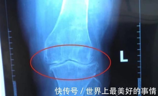 骨骺线|男生多少岁会“停止长高”?不是18,也不是22,而是这个年纪