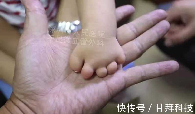 男孩|得了这病,12岁男孩手指比香蕉还粗!7种常见的手部畸形,家长们要注意