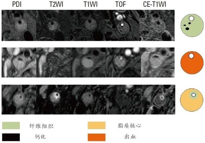 斑块|新技术！淄博市中心医院头颈部高分辨MR血管壁成像：让斑块立显