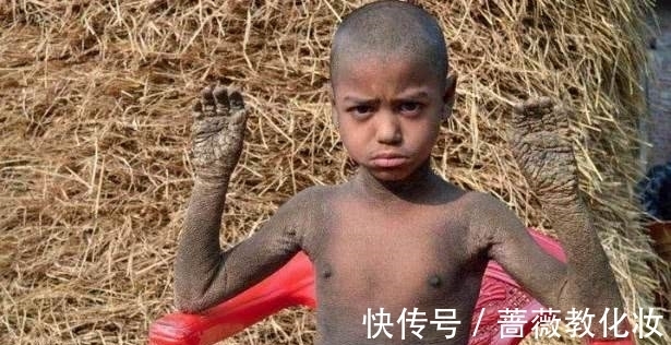 输入图片描述|8岁黑人小孩得怪病,手和脚开始“石化”,医生的话让家人崩溃!