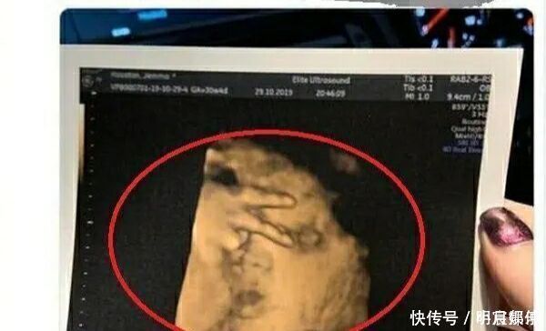 发育|迫不及待想看孩子,四维彩超时宝宝却比个“v”,医生忍不住笑了