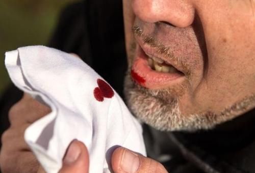 患上肺结节后，身体可能会有4个表现，不妨了解一下