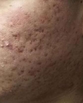 后果|全民护肤日：这些后果严重的皮肤病，却常常被忽视