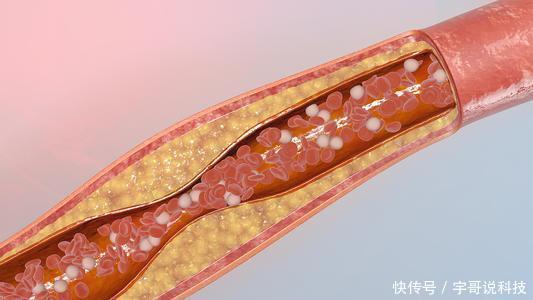  血管疾病|不想老年痴呆症找上你，做好5件事，大脑越来越年轻