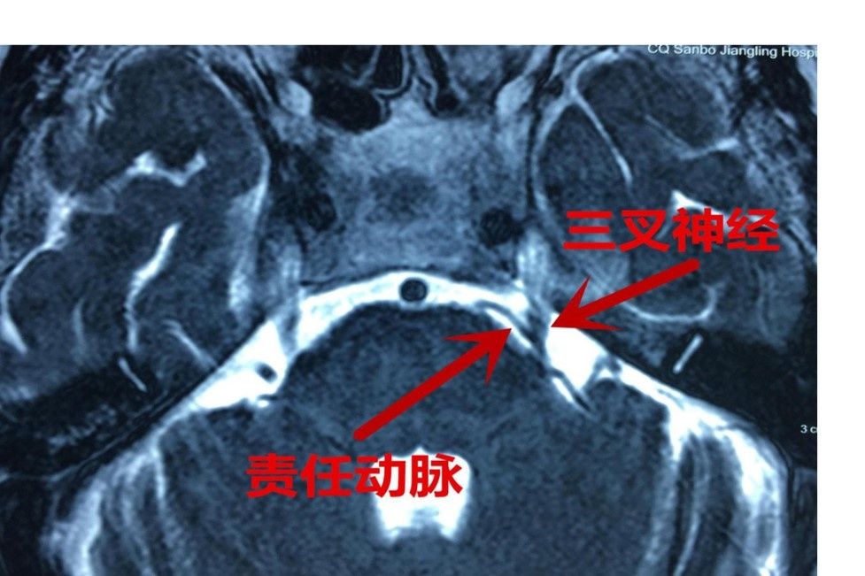 血管|微血管减压术治疗颅神经疾病的经验与体会