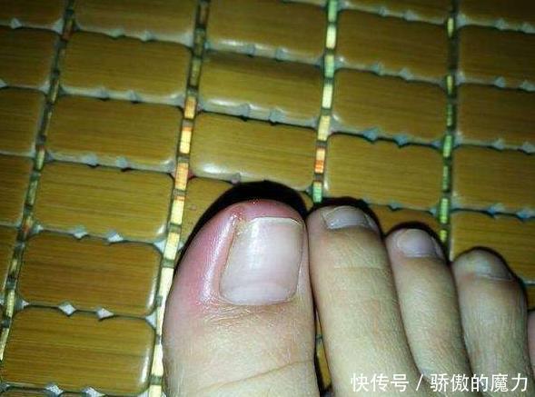  指甲沟炎症|甲沟炎究竟是何方妖孽为何总是折磨我