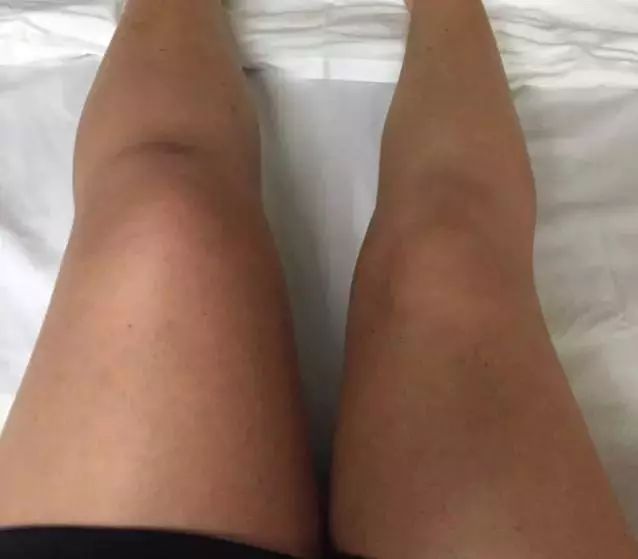 深静脉血栓|血栓形成后，腿脚容易出现4个异常，若一个没有，血管还算通畅