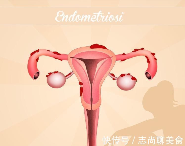 白带增多|得了子宫肌瘤的人，都会有这5个难堪，别不承认