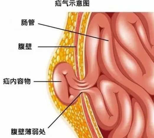 小伙|27岁小伙拉黑便查出这种癌症！家人却选择了放弃治疗…