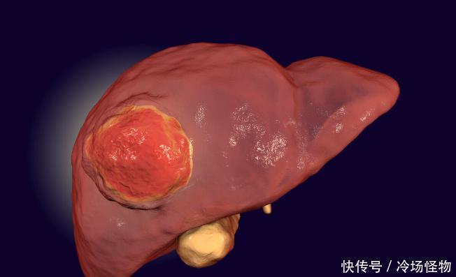 肝癌患者|什么是“带瘤生存”这名15公分巨大型肝癌患者是如何实现的