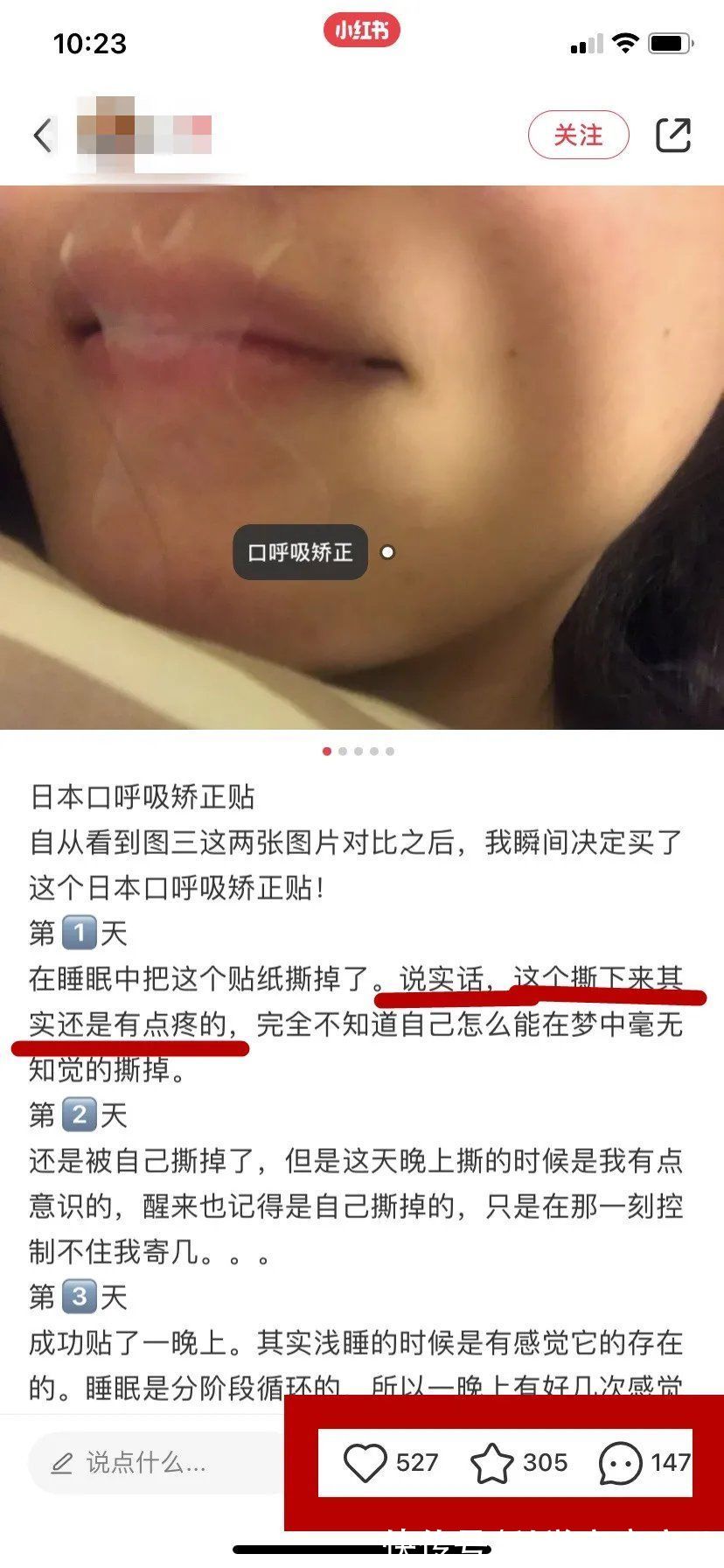 隐患|月销10万＋的口呼吸贴，别再给娃用了！背后的隐患医生都捏把汗