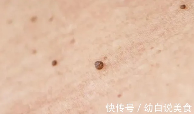 宫颈癌|21岁女子查出宫颈癌,医生皮肤3个异常,或不是过敏,建议了解