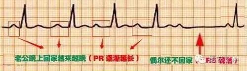 护士这样学心电图，不用死记硬背