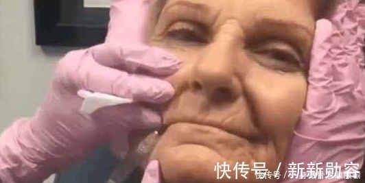 美美|80岁奶奶打玻尿酸,仿佛年轻了40岁:老了也要美美的