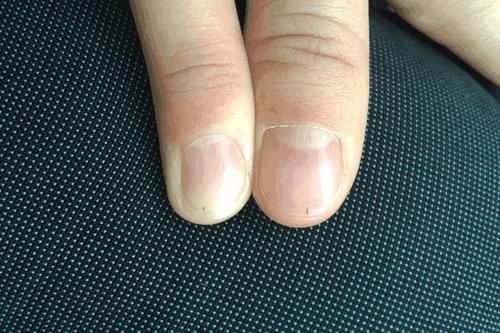竖纹|指甲变成这样,预示大病很快来临,赶紧重视起来吧!