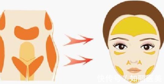 自体脂肪 自体脂肪填充术后能保持多久,会不会很快代谢掉?