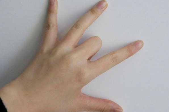 疹子|手部出现四大变化,有可能是血糖过高,不占说明血糖还稳定