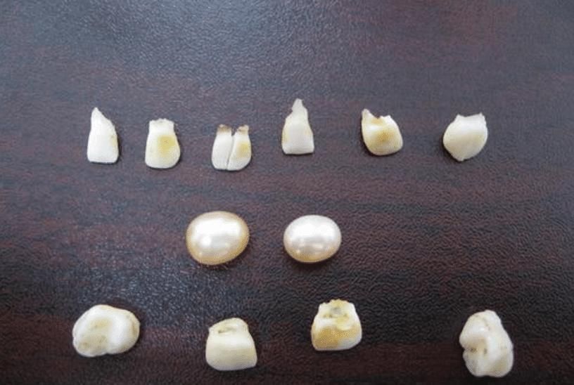 牙齿|95后宝妈不信乳牙能救命,结果后悔不已,新手爸妈要注意