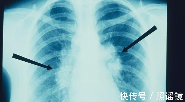 活动度|结节就是早癌?作为全身几十枚结节的医生,有些话想对结节患者说