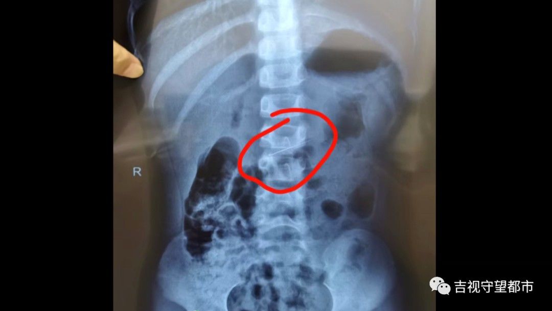 消化道|牙修一半针没了！胃内发现修牙针...