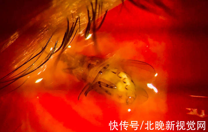 虫子|50岁大妈眼内竟有一只“苍蝇”？！医生：幸运的是……
