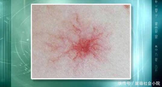 人体|肝脏生病,头部先知?医生建议:若出现4种异常,尽早做CT检查