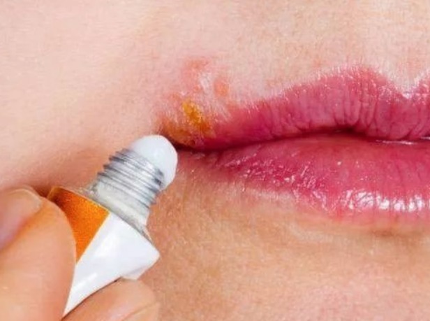 把红霉素软膏抹鼻子上效果好,红霉素软膏3个神奇妙用,值得尝试