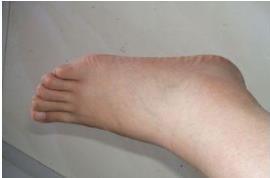 张医师|当血管堵塞时，脚部可能会发出信号，你若没有，表明血栓离你还远