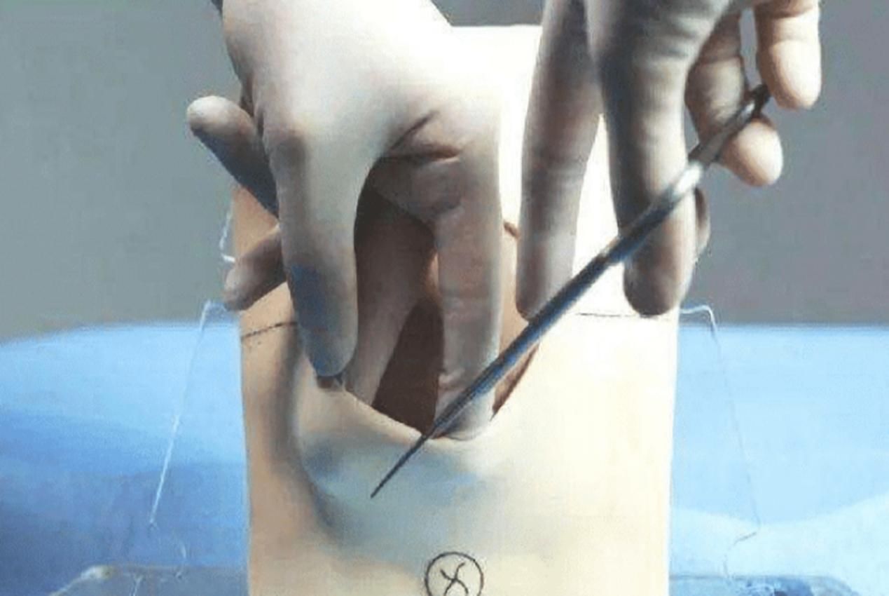 侧切|顺产也可能“挨一刀”,自然撕裂和人为侧切,孕妈更愿意接受哪个