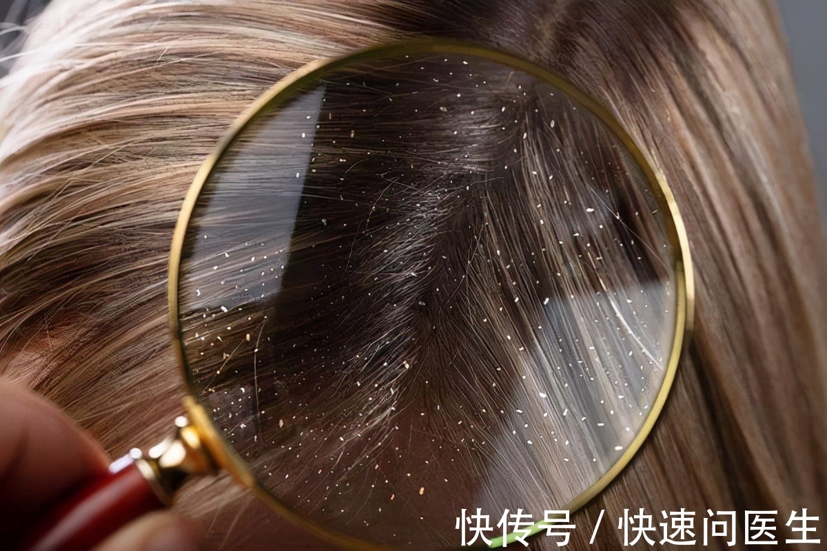 出油|为什么头发总是爱出油?明白这6个原因,别让头发越洗越油