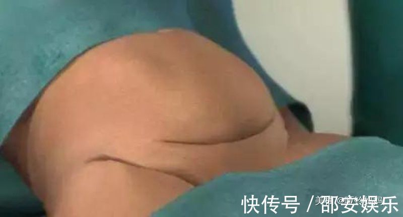 腹直肌|一组图带你了解剖腹产的整个过程:每位产妇都是超人,老公该看看