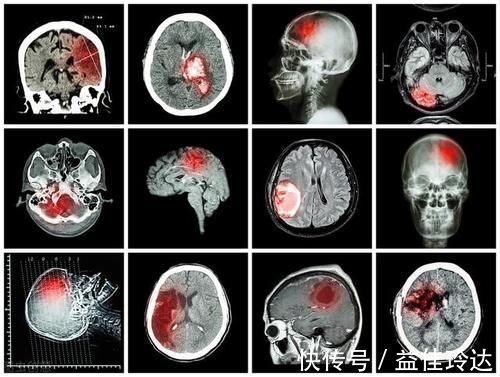 高脂血症|老年人高血脂危害大，世界权威医学杂志：70岁开始降脂也不算晚