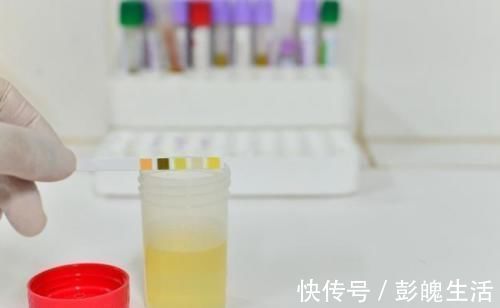 血糖控制|糖尿病患者尿中泡沫多,多是肾不行了?做好2事,也许能改善