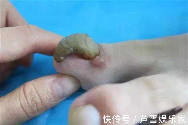 甲周|16岁少女6年没剪过趾甲,这酸爽,简直不忍直视,青少年应注意