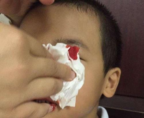 乐乐|4岁男孩鼻血不止，送医院被告知“无法抢救”，只因宝妈这一举动