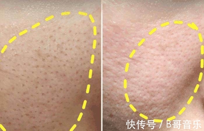 毛孔|难怪毛孔越来越大,原来是这5个坏习惯导致的,很多人每天都在做