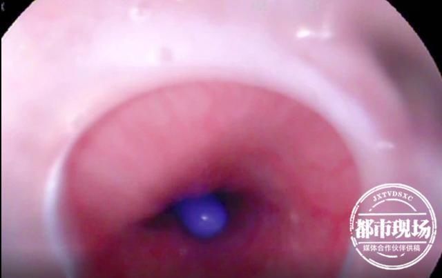 牙刷|20厘米长17岁少年刷牙时吞掉它,医生20多年来第一次见