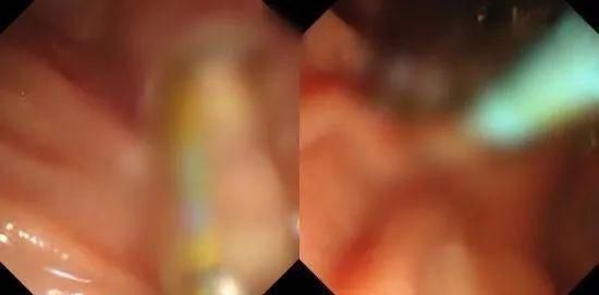 医疗团队|得了癌症还被拒绝手术？88岁阿婆幸亏遇上了这个医疗团队！