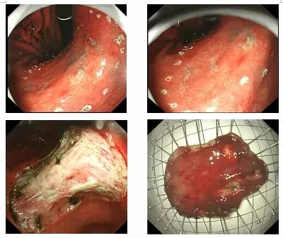 朱靖宇|62岁患者早期发现胃角粘膜内高中分化管状腺癌，内镜粘膜下剥离术（内镜ESD）早诊早治效果佳