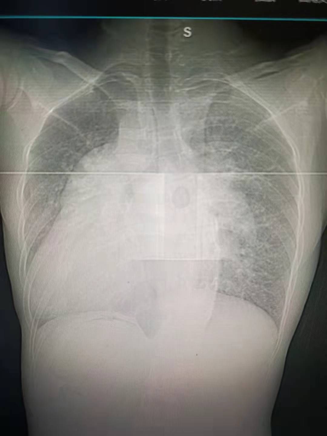 手术|男子就医意外发现自己是罕见“镜像人”，五脏六腑全长反，医生这波“反向操作”厉害了