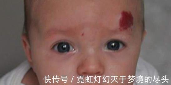 畸形|不想宝宝长胎记,孕妇就忍住别做这4件事,颜值是一辈子的事