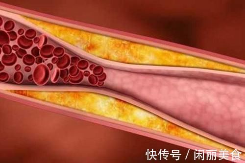 饮食习惯|血管为什么一年比一年堵，什么食物可以给血管“洗澡”？