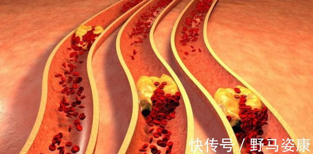 血脂|低密度脂蛋白越低越好吗？如何控制血脂指标，医生为你详解