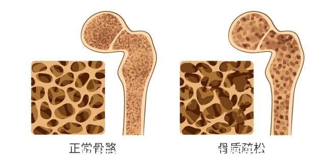 骨代谢|天天补钙还是出现骨质疏松？关于骨质疏松的几大误区你中了吗？