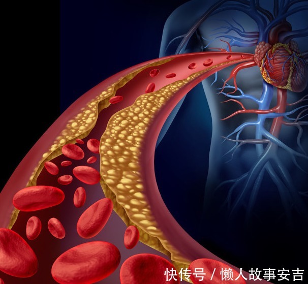 血脂高的人,不想脑梗“来敲门”,厨房内3味调料,建议少吃