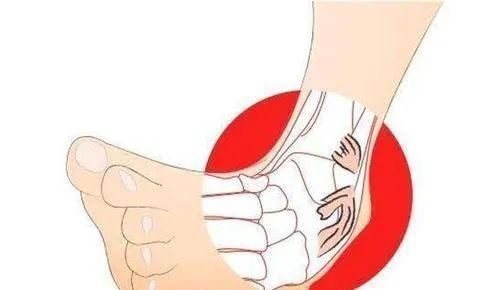 脚踝韧带撕裂多久消肿 脚踝韧带撕裂多久消肿