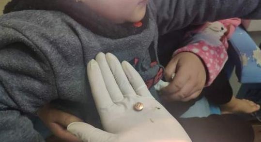 物件|5岁男孩吞入纽扣电池,妈妈急中生智的做法,让医生都点赞